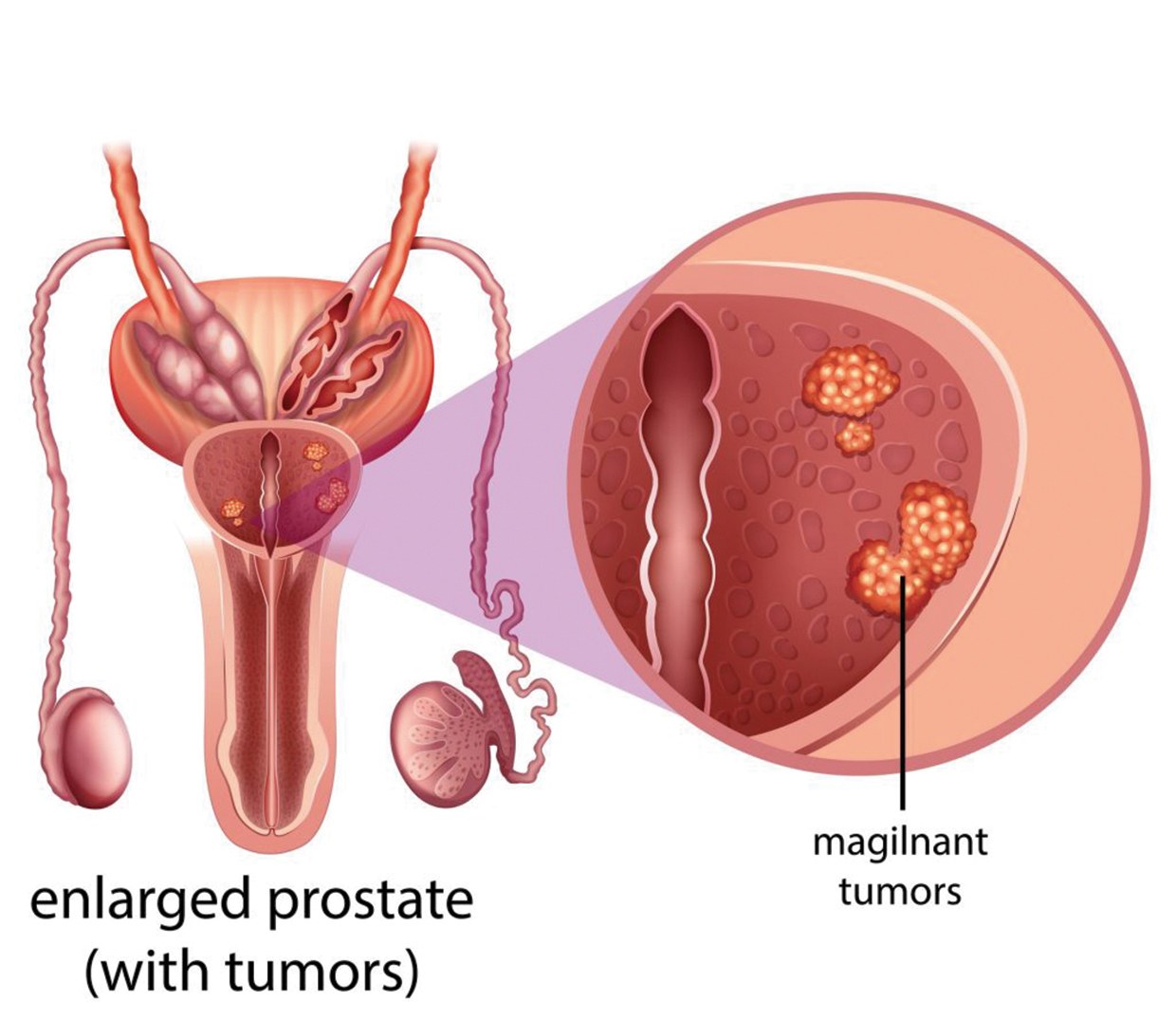 Cancro della prostata ed esame del profilo di rischio cardiovascolare: un nuovo approccio diagnostico e teraputico.